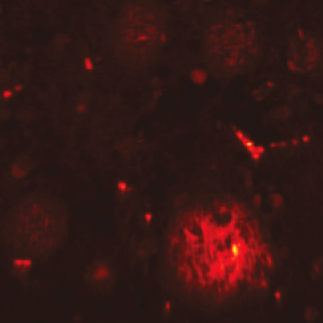 Neurodegeneration